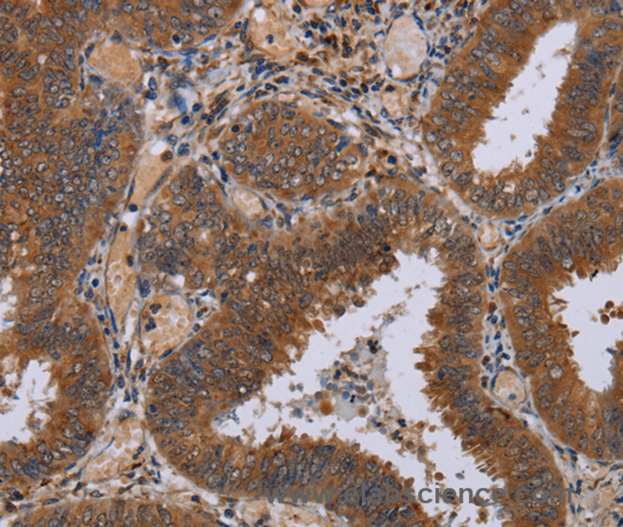 Immunohistochemistry of paraffin-embedded Human colon cancer tissue using NPTX1 Polyclonal Antibody at dilution 1:50