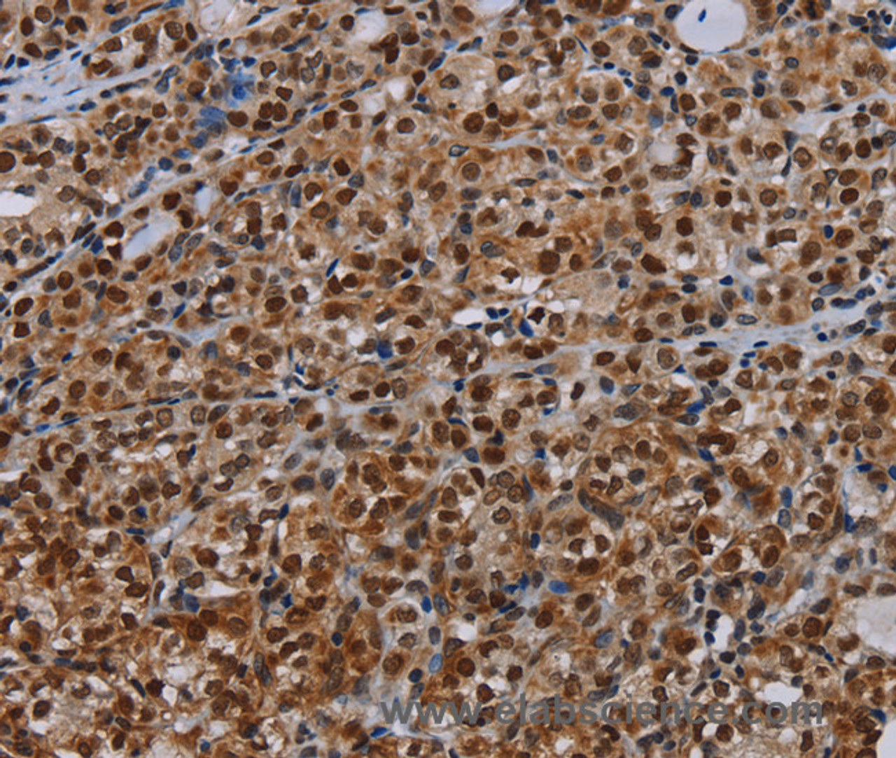 Immunohistochemistry of paraffin-embedded Human thyroid cancer tissue using DCAF6 Polyclonal Antibody at dilution 1:30