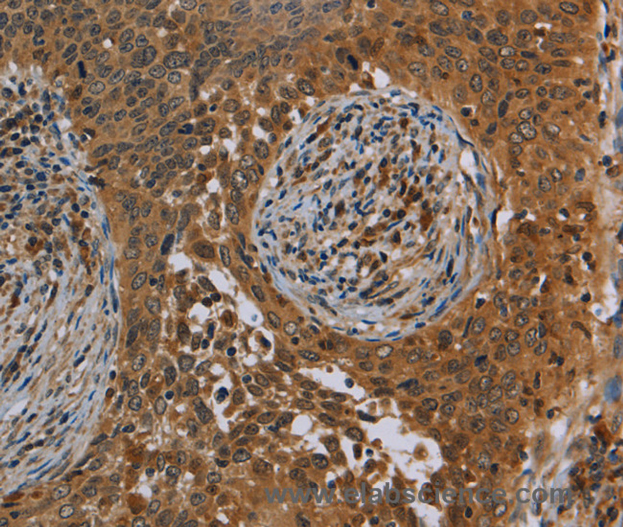 Immunohistochemistry of paraffin-embedded Human cervical cancer tissue using OSM Polyclonal Antibody at dilution 1:40