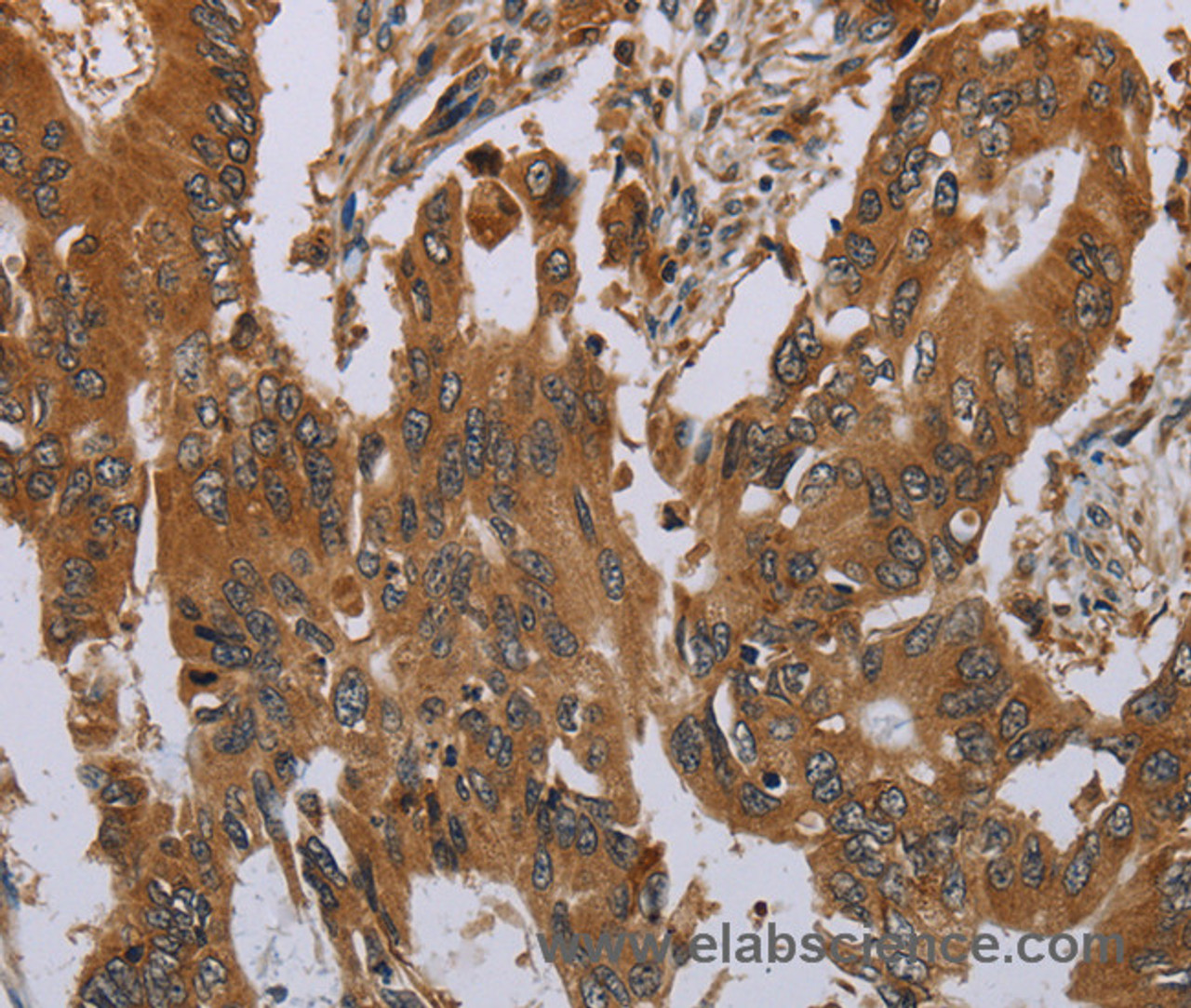 Immunohistochemistry of paraffin-embedded Human colon cancer tissue using OSM Polyclonal Antibody at dilution 1:40