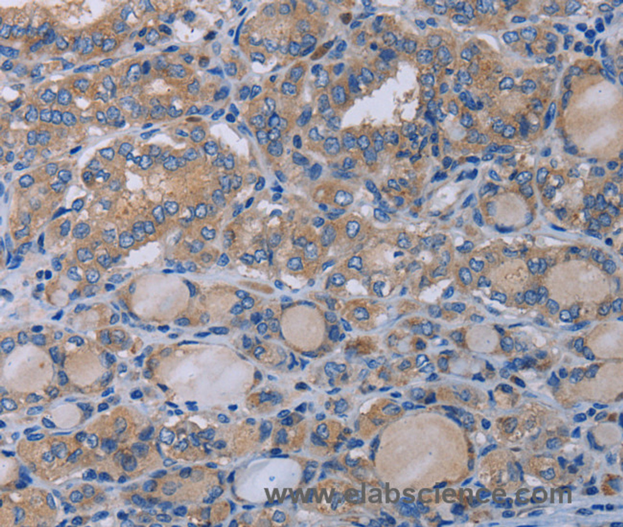 Immunohistochemistry of paraffin-embedded Human thyroid cancer using P2RX3 Polyclonal Antibody at dilution of 1:50
