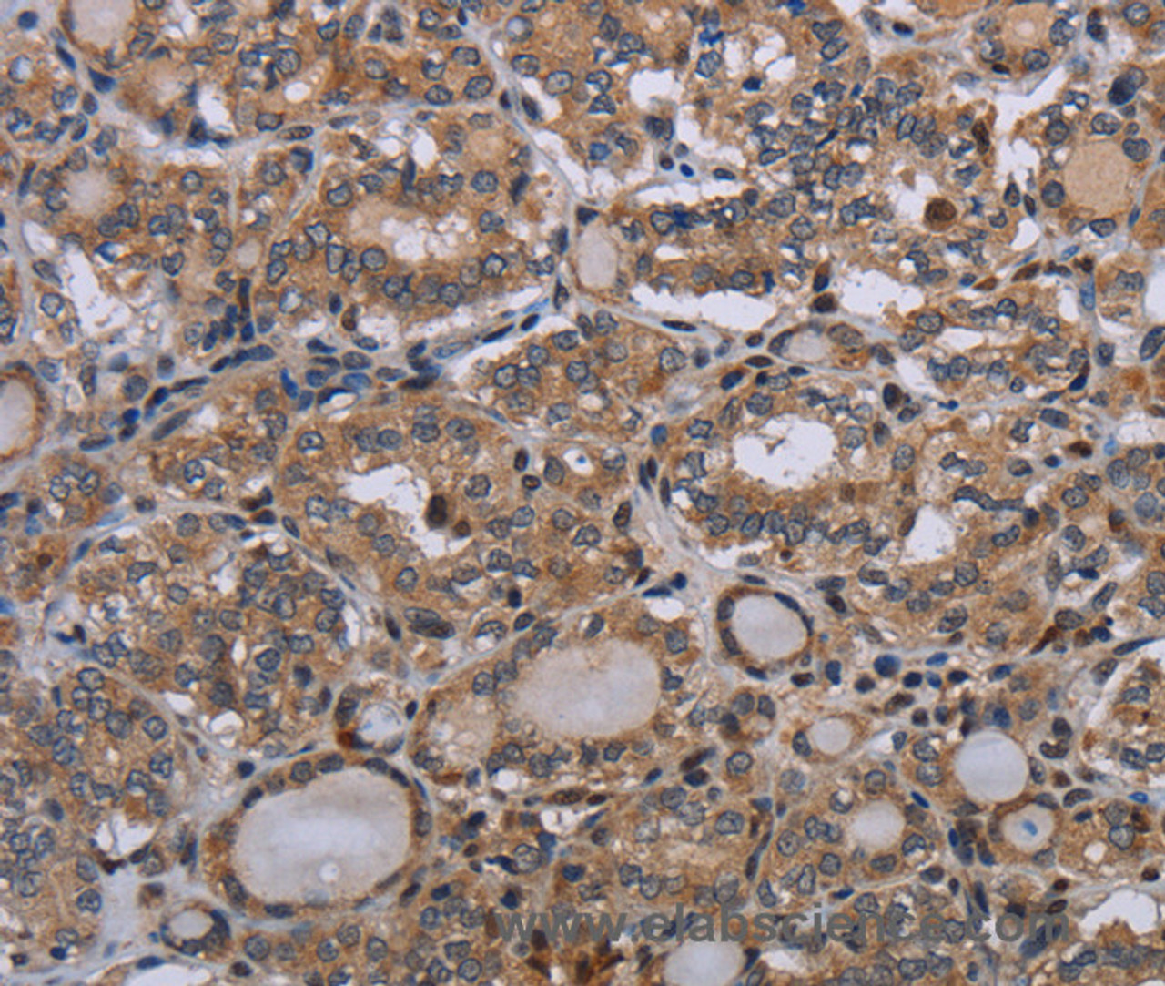 Immunohistochemistry of paraffin-embedded Human thyroid cancer using P2RX2 Polyclonal Antibody at dilution of 1:50