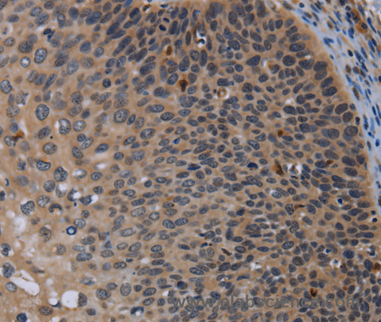 Immunohistochemistry of paraffin-embedded Human cervical cancer using P2RX2 Polyclonal Antibody at dilution of 1:50
