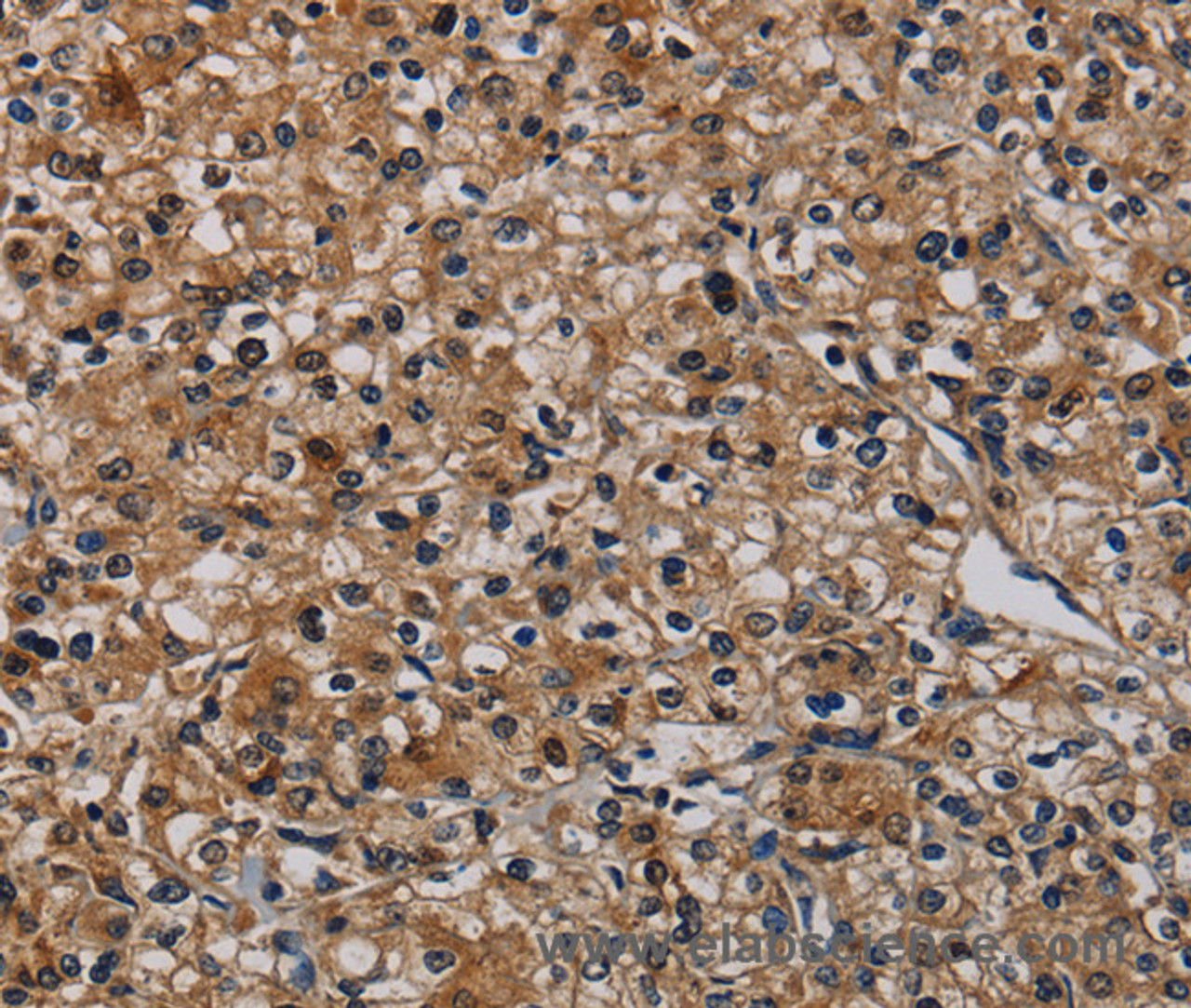Immunohistochemistry of paraffin-embedded Human prostate cancer using TP53INP1 Polyclonal Antibody at dilution of 1:50