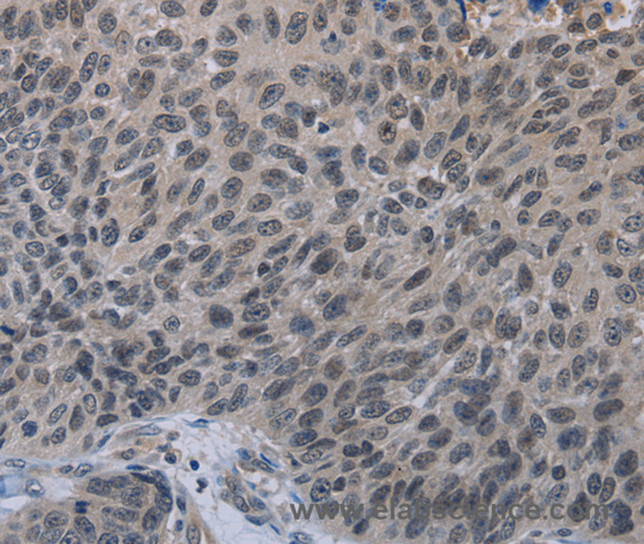 Immunohistochemistry of paraffin-embedded Human lung cancer tissue using TP53AIP1 Polyclonal Antibody at dilution 1:50