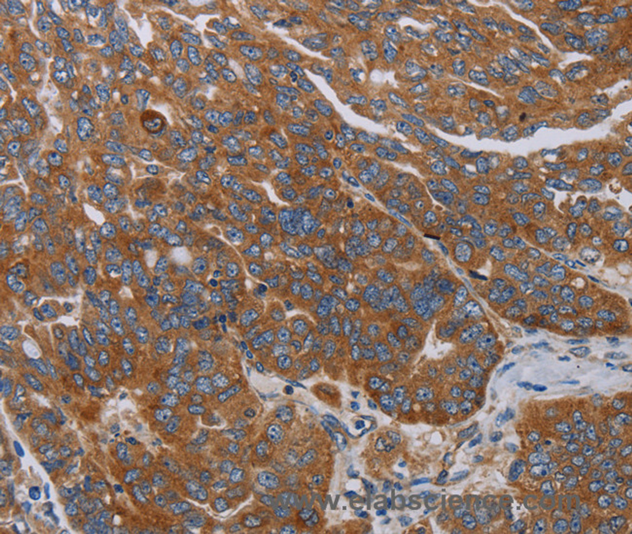 Immunohistochemistry of paraffin-embedded Human ovarian cancer tissue using PARP10 Polyclonal Antibody at dilution 1:30