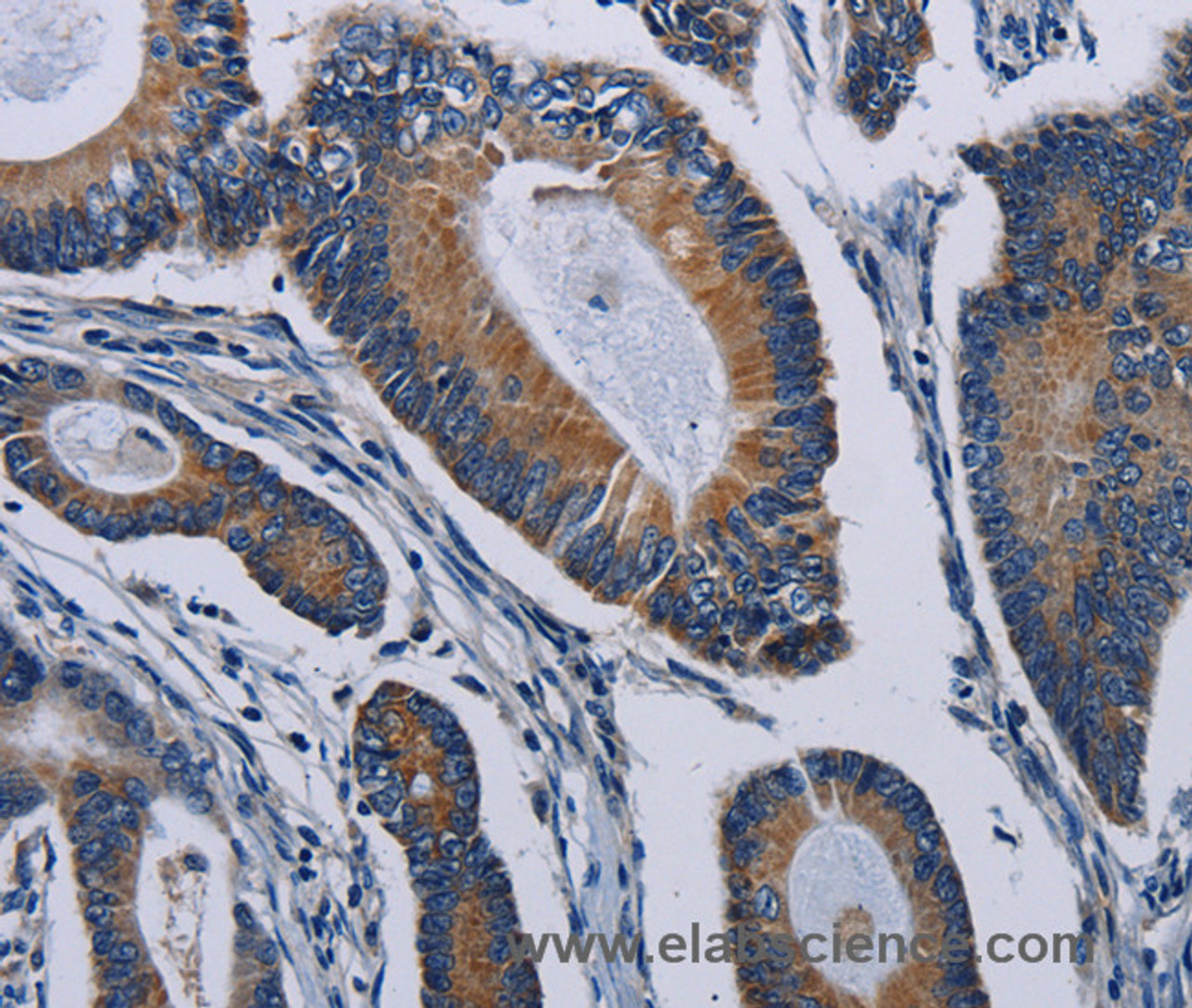 Immunohistochemistry of paraffin-embedded Human colon cancer tissue using PCDHAC2 Polyclonal Antibody at dilution 1:50