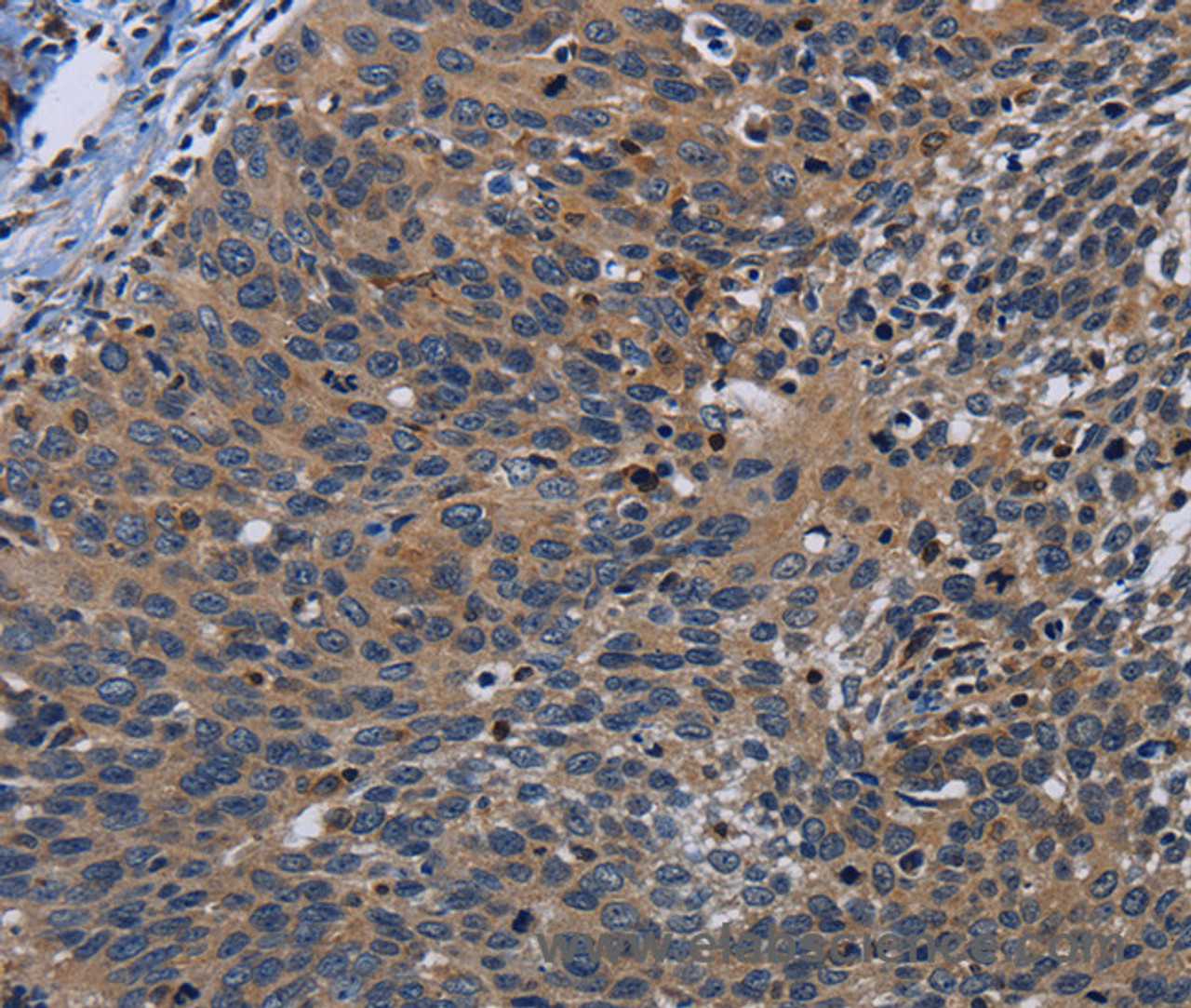 Immunohistochemistry of paraffin-embedded Human cervical cancer tissue using PCDHB15 Polyclonal Antibody at dilution 1:50