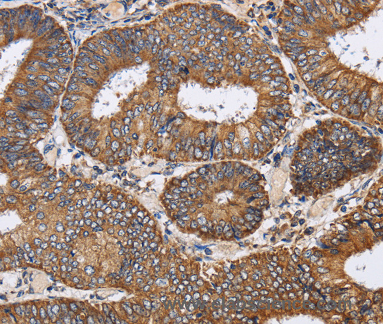 Immunohistochemistry of paraffin-embedded Human colon cancer tissue using PDGFC Polyclonal Antibody at dilution 1:40