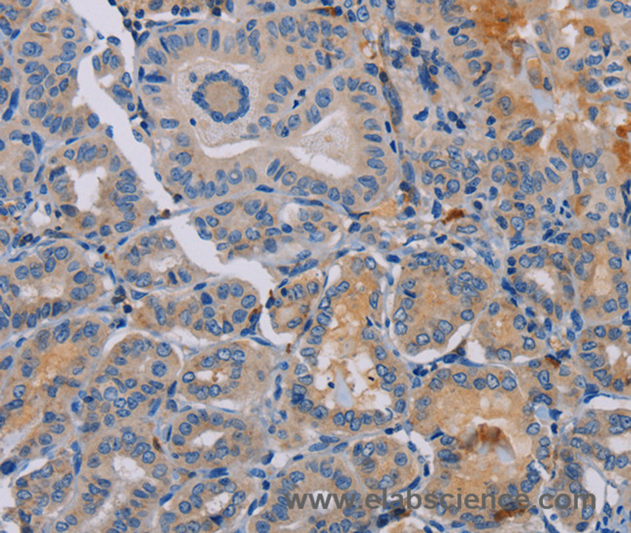 Immunohistochemistry of paraffin-embedded Human thyroid cancer tissue using PYY Polyclonal Antibody at dilution 1:30