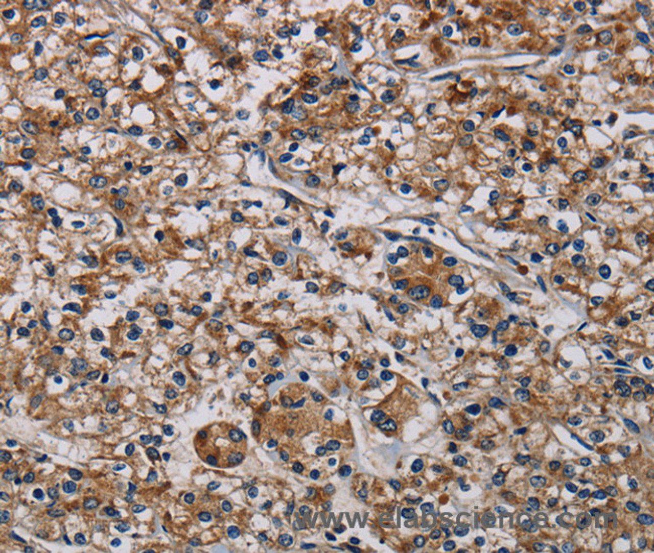 Immunohistochemistry of paraffin-embedded Human prostate cancer tissue using PLIN3 Polyclonal Antibody at dilution 1:40