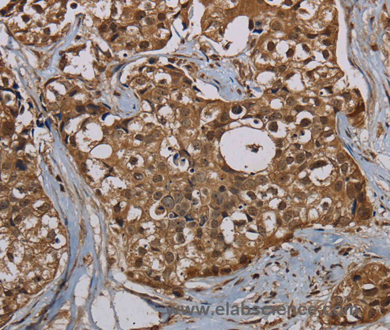 Immunohistochemistry of paraffin-embedded Human breast cancer tissue using PNN Polyclonal Antibody at dilution 1:50
