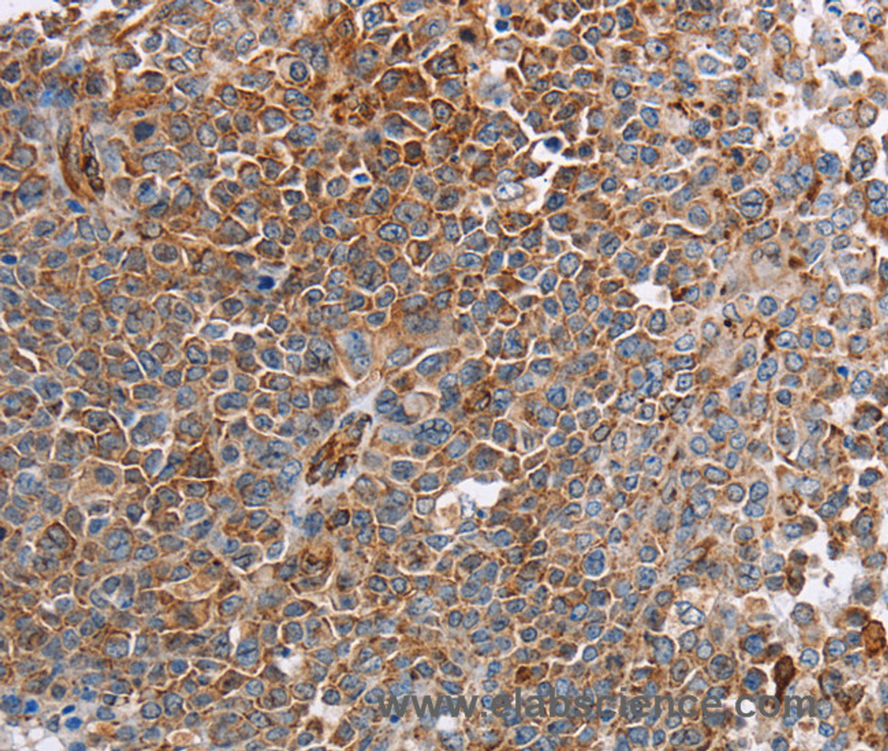 Immunohistochemistry of paraffin-embedded Human ovarian cancer tissue using PLXNA2 Polyclonal Antibody at dilution 1:40