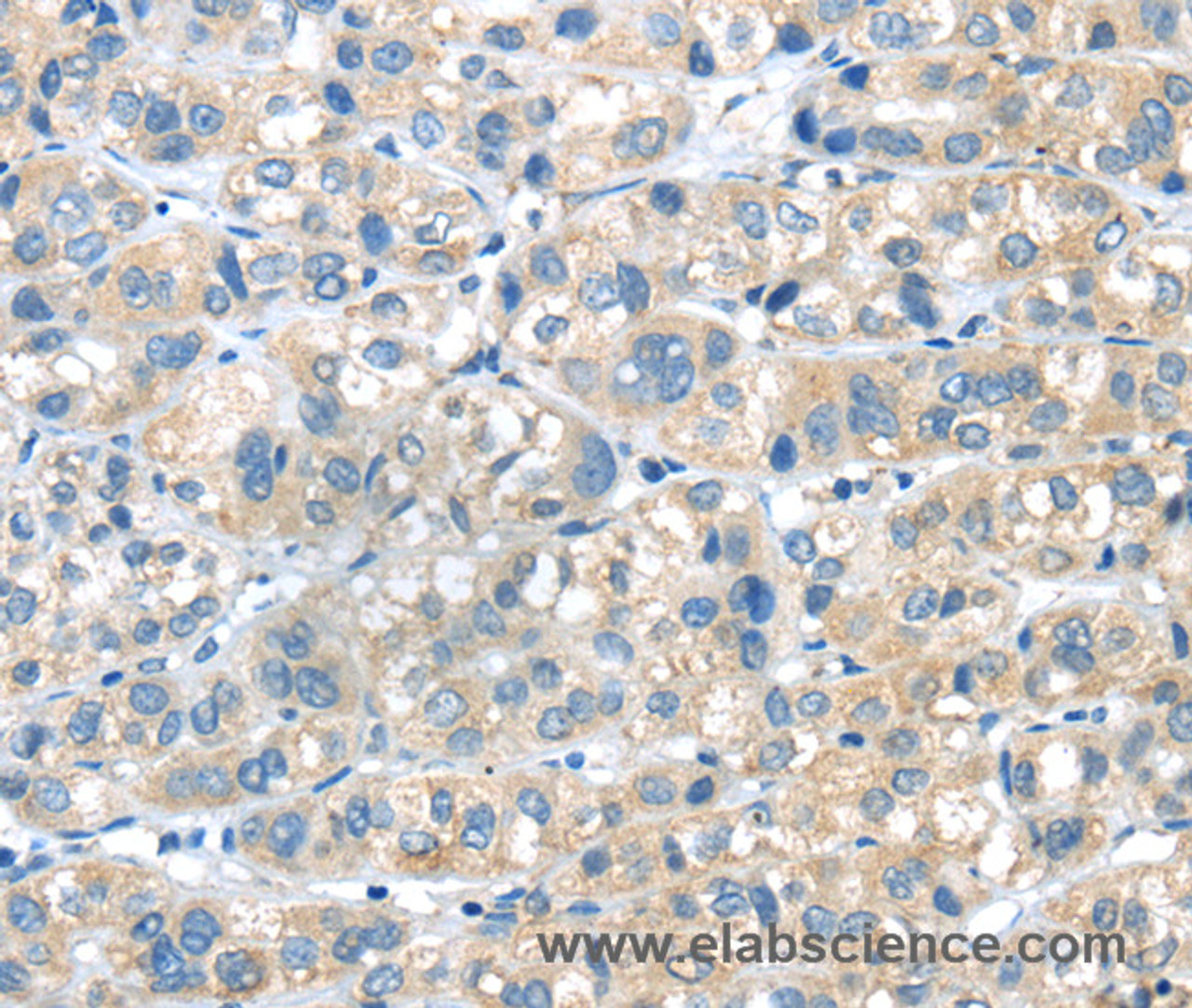 Immunohistochemistry of paraffin-embedded Human liver cancer tissue using PLXNA2 Polyclonal Antibody at dilution 1:40