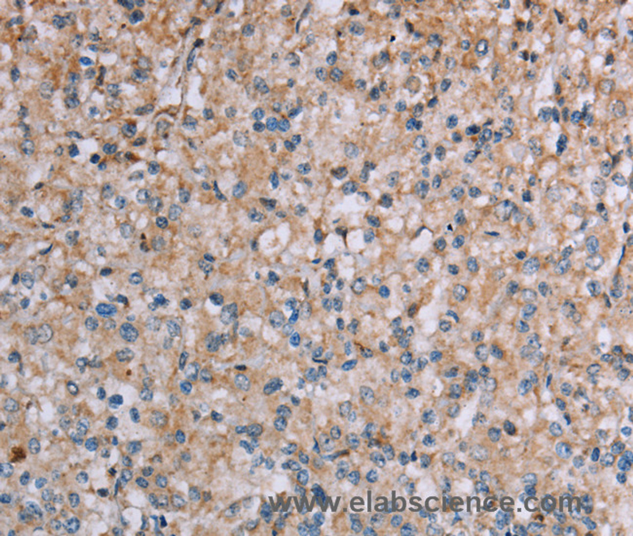 Immunohistochemistry of paraffin-embedded Human prostate cancer tissue using PLXNA4 Polyclonal Antibody at dilution 1:50