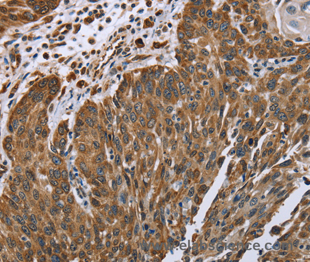 Immunohistochemistry of paraffin-embedded Human lung cancer tissue using PLXNB1 Polyclonal Antibody at dilution 1:40