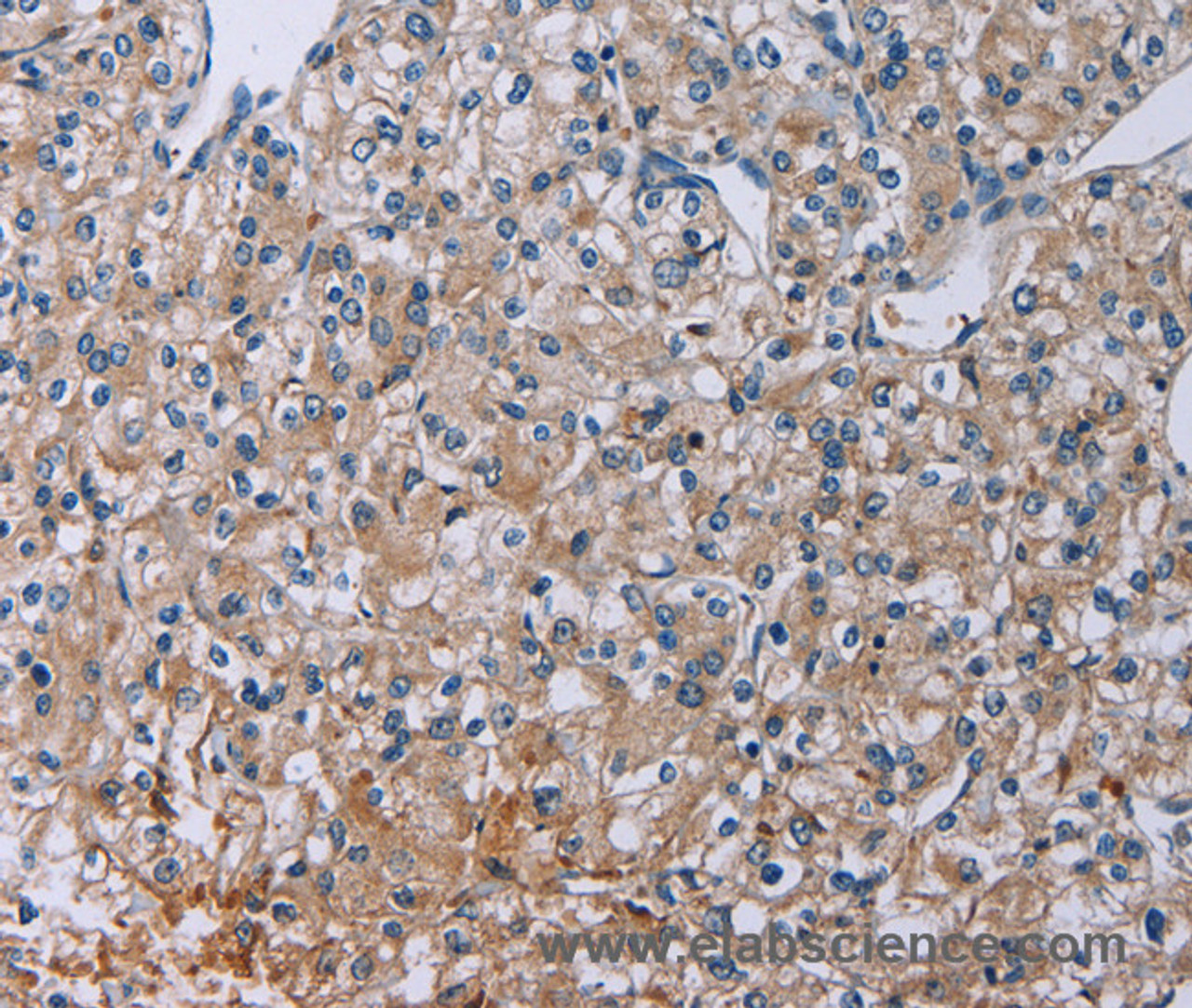 Immunohistochemistry of paraffin-embedded Human prostate cancer tissue using PLXND1 Polyclonal Antibody at dilution 1:40