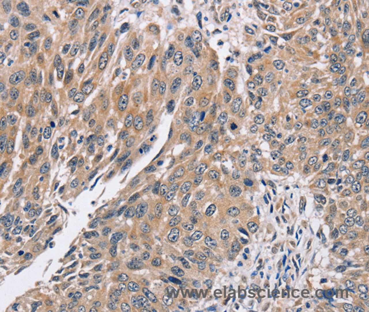 Immunohistochemistry of paraffin-embedded Human lung cancer using PPP1CC Polyclonal Antibody at dilution of 1:40