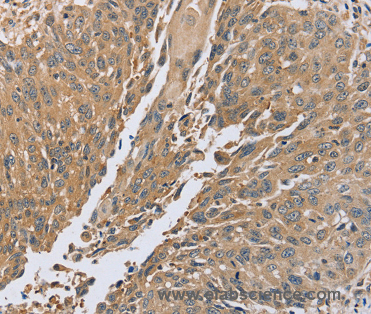 Immunohistochemistry of paraffin-embedded Human lung cancer using PTPN12 Polyclonal Antibody at dilution of 1:45