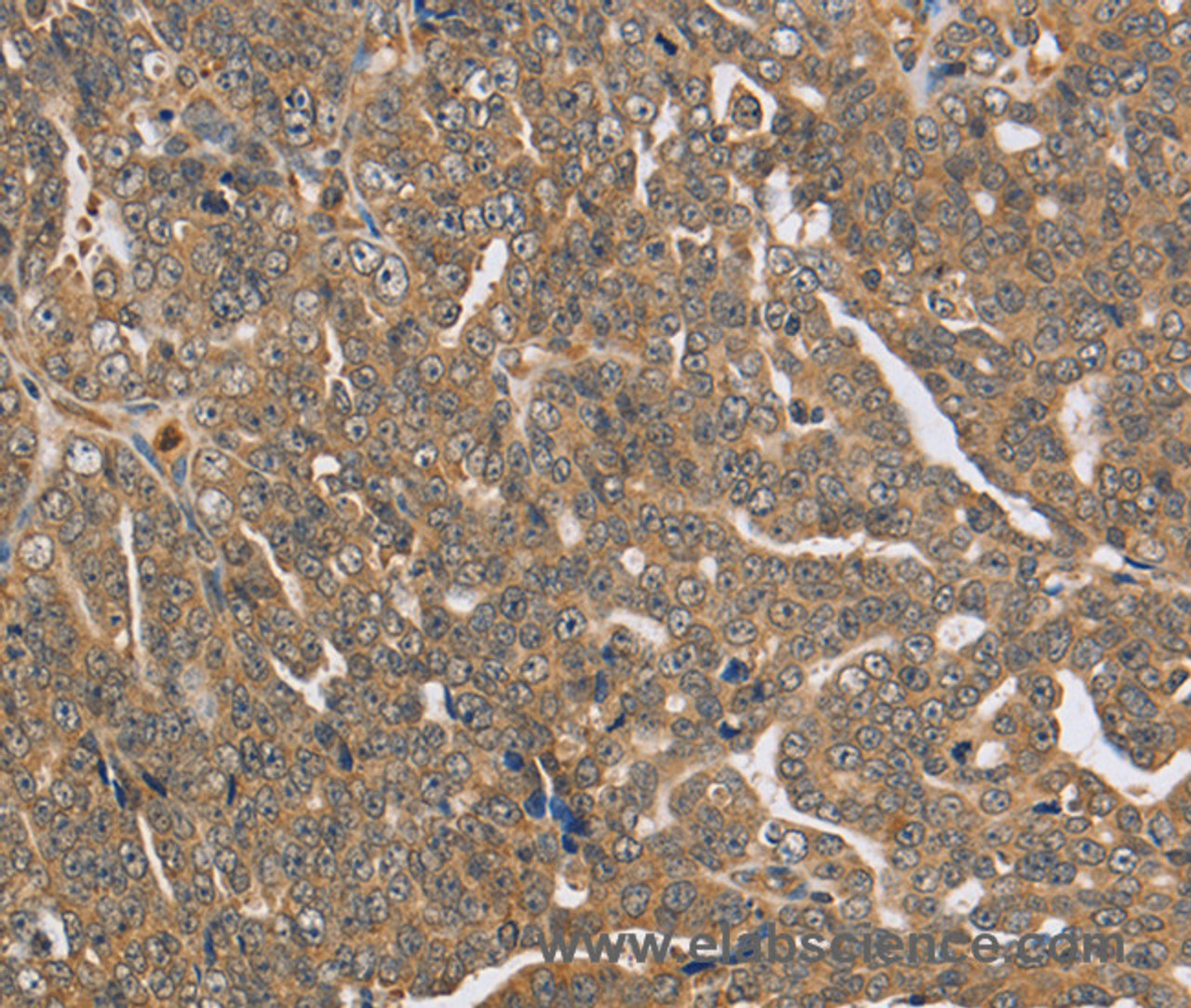 Immunohistochemistry of paraffin-embedded Human cervical cancer using PTPN12 Polyclonal Antibody at dilution of 1:45