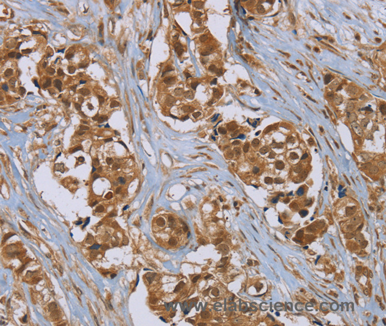 Immunohistochemistry of paraffin-embedded Human breast cancer using PUS10 Polyclonal Antibody at dilution of 1:45