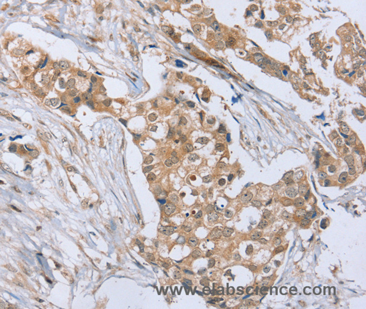 Immunohistochemistry of paraffin-embedded Human breast cancer tissue using RAB8B Polyclonal Antibody at dilution 1:45