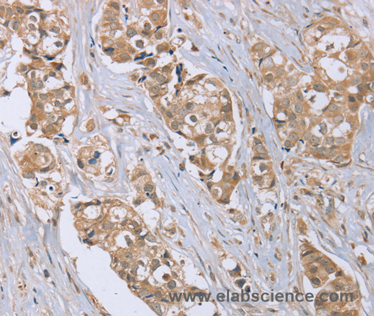 Immunohistochemistry of paraffin-embedded Human breast cancer tissue using RAB6C Polyclonal Antibody at dilution 1:45