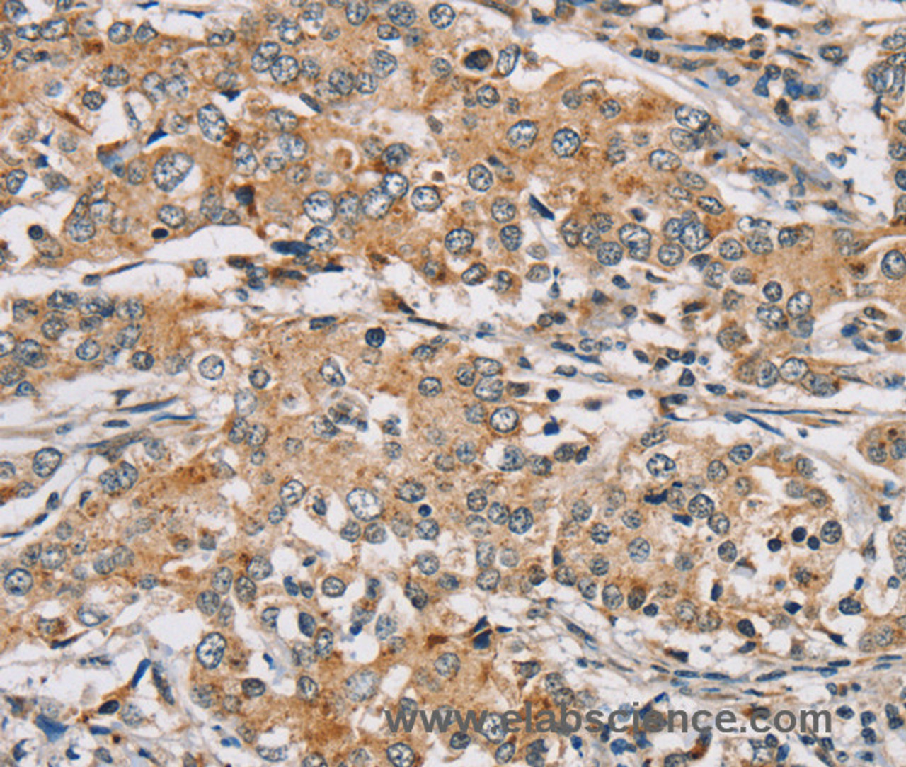 Immunohistochemistry of paraffin-embedded Human liver cancer tissue using RAB24 Polyclonal Antibody at dilution 1:45