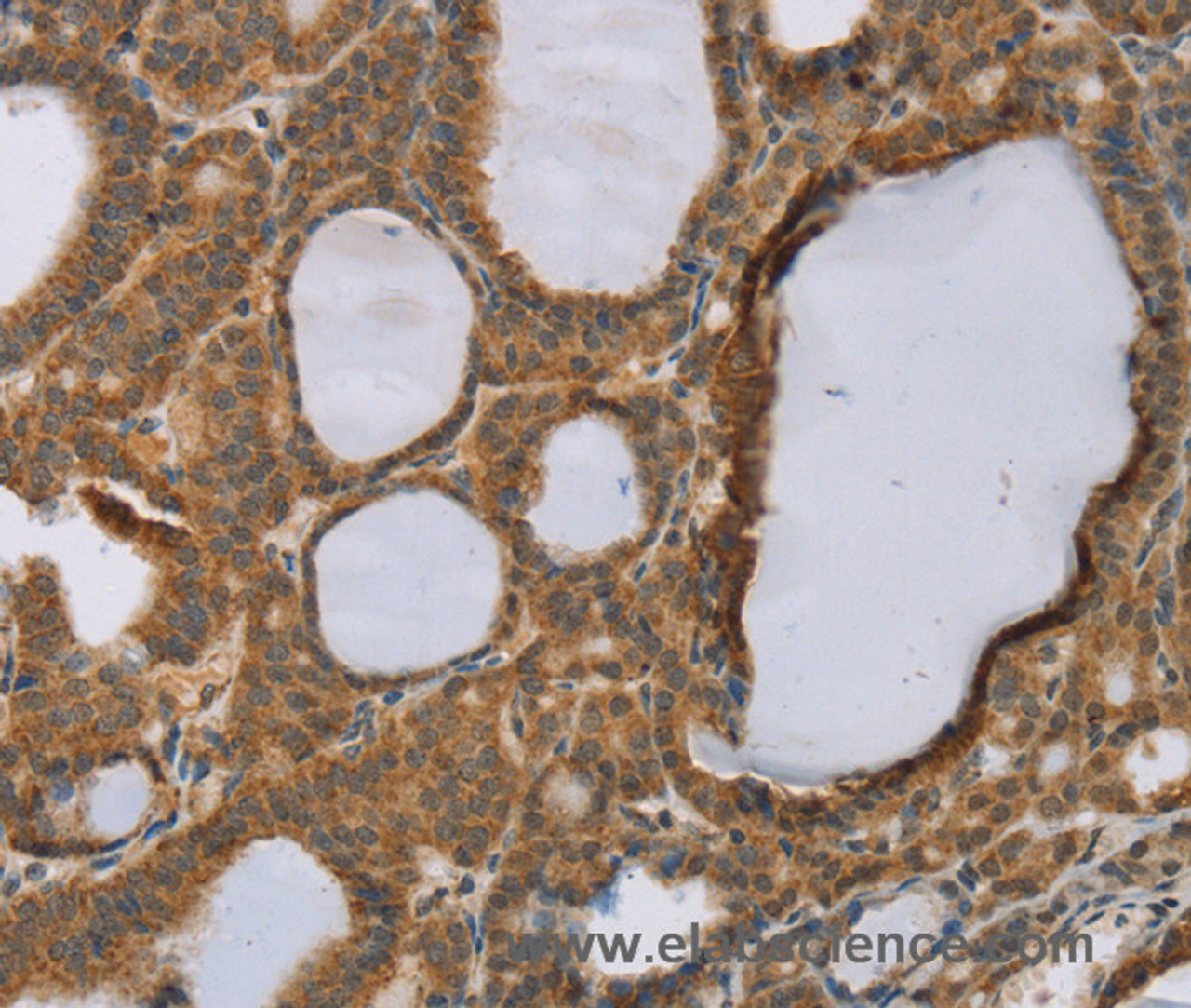 Immunohistochemistry of paraffin-embedded Human thyroid cancer using RNF5 Polyclonal Antibody at dilution of 1:35