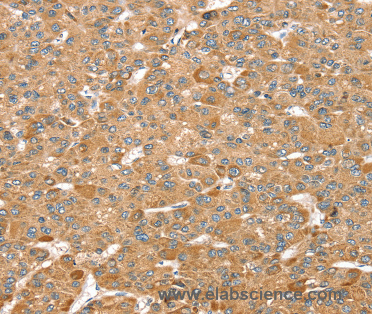 Immunohistochemistry of paraffin-embedded Human liver cancer using MORF4L1 Polyclonal Antibody at dilution of 1:35