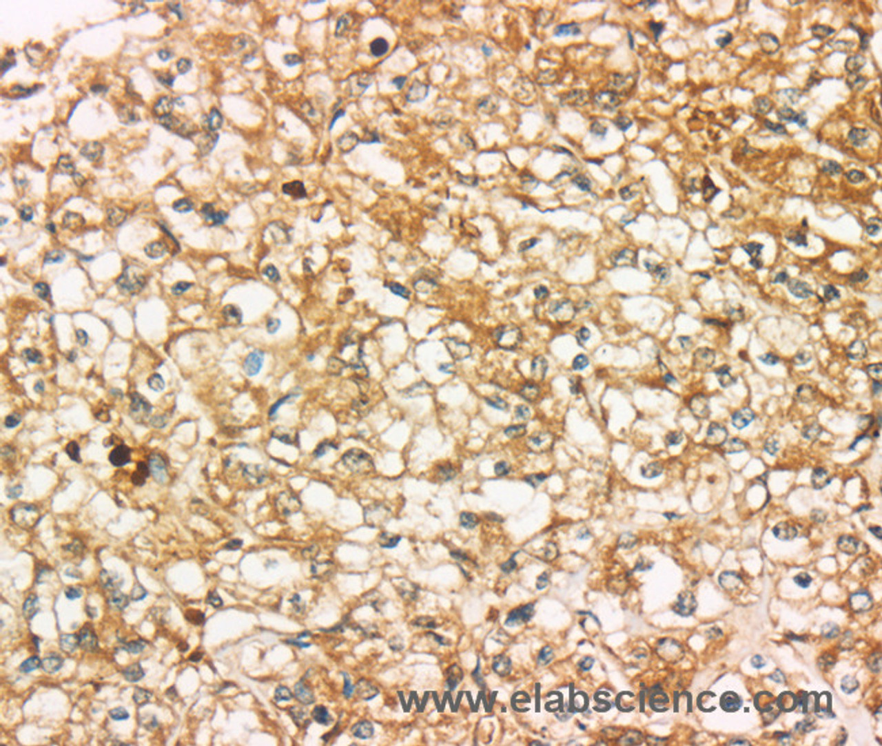 Immunohistochemistry of paraffin-embedded Human prostate cancer using SIGLEC15 Polyclonal Antibody at dilution of 1:35