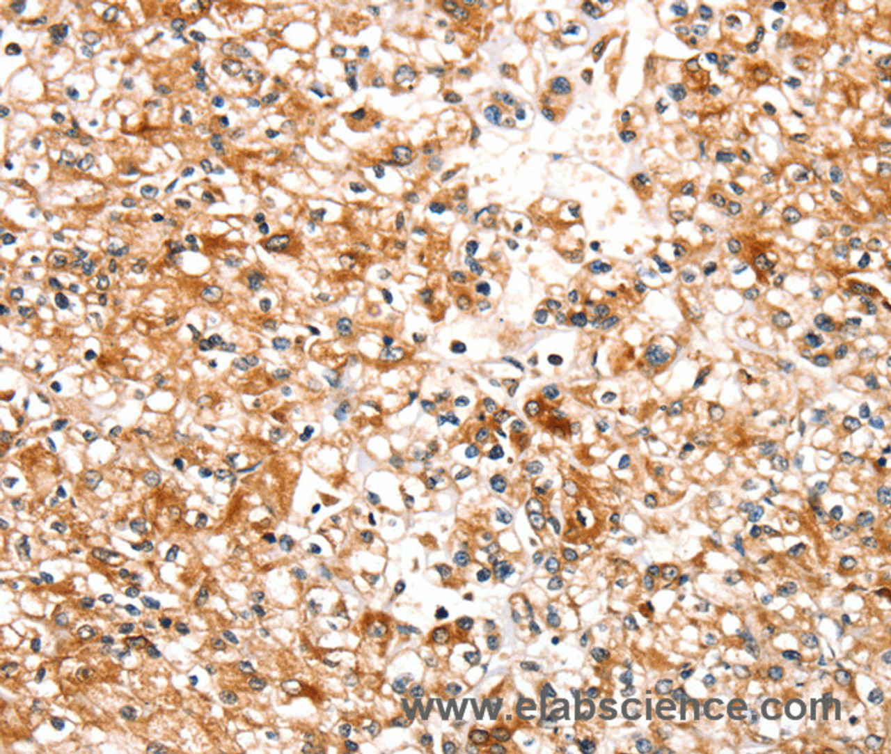 Immunohistochemistry of paraffin-embedded Human prostate cancer tissue using SLC25A12 Polyclonal Antibody at dilution 1:30