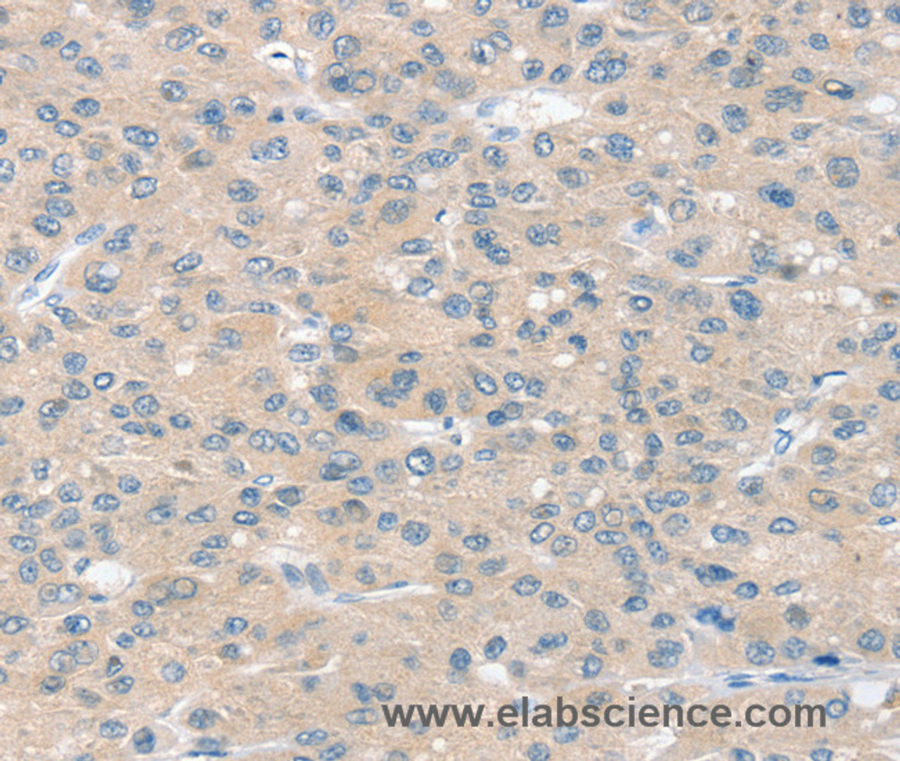 Immunohistochemistry of paraffin-embedded Human liver cancer using SLIT2 Polyclonal Antibody at dilution of 1:30