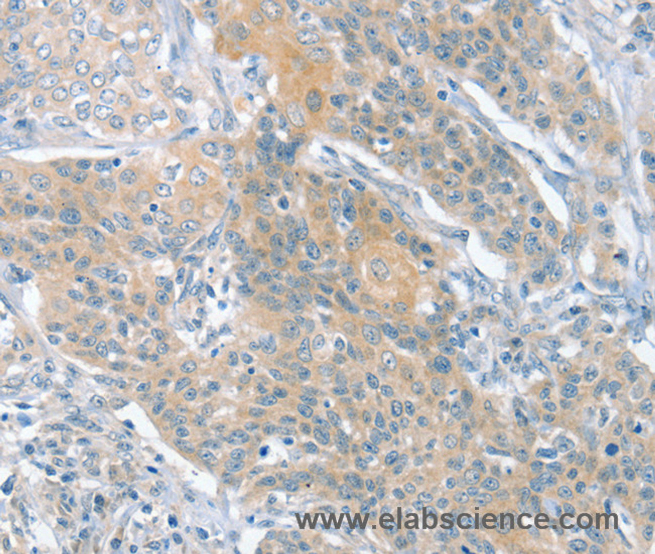 Immunohistochemistry of paraffin-embedded Human cervical cancer using SLIT2 Polyclonal Antibody at dilution of 1:30