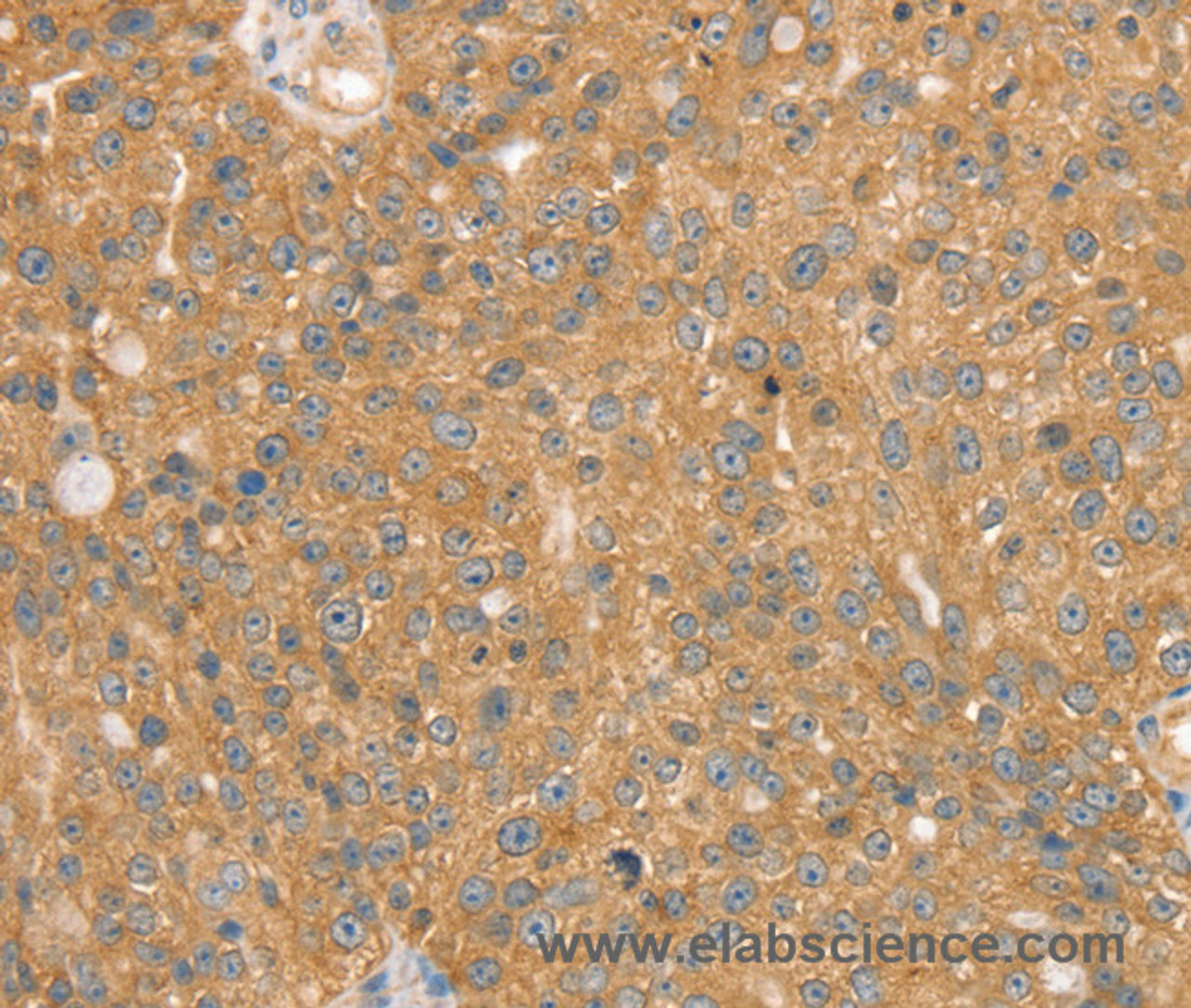 Immunohistochemistry of paraffin-embedded Human breast cancer using SNX2 Polyclonal Antibody at dilution of 1:40