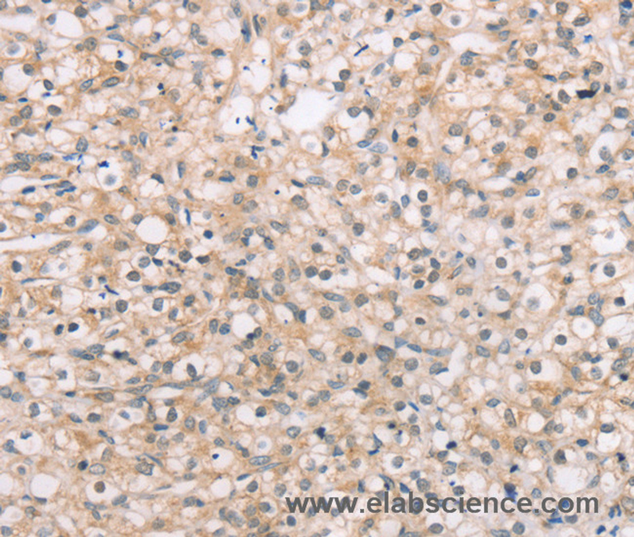 Immunohistochemistry of paraffin-embedded Human prostate cancer tissue using ROR1 Polyclonal Antibody at dilution 1:45