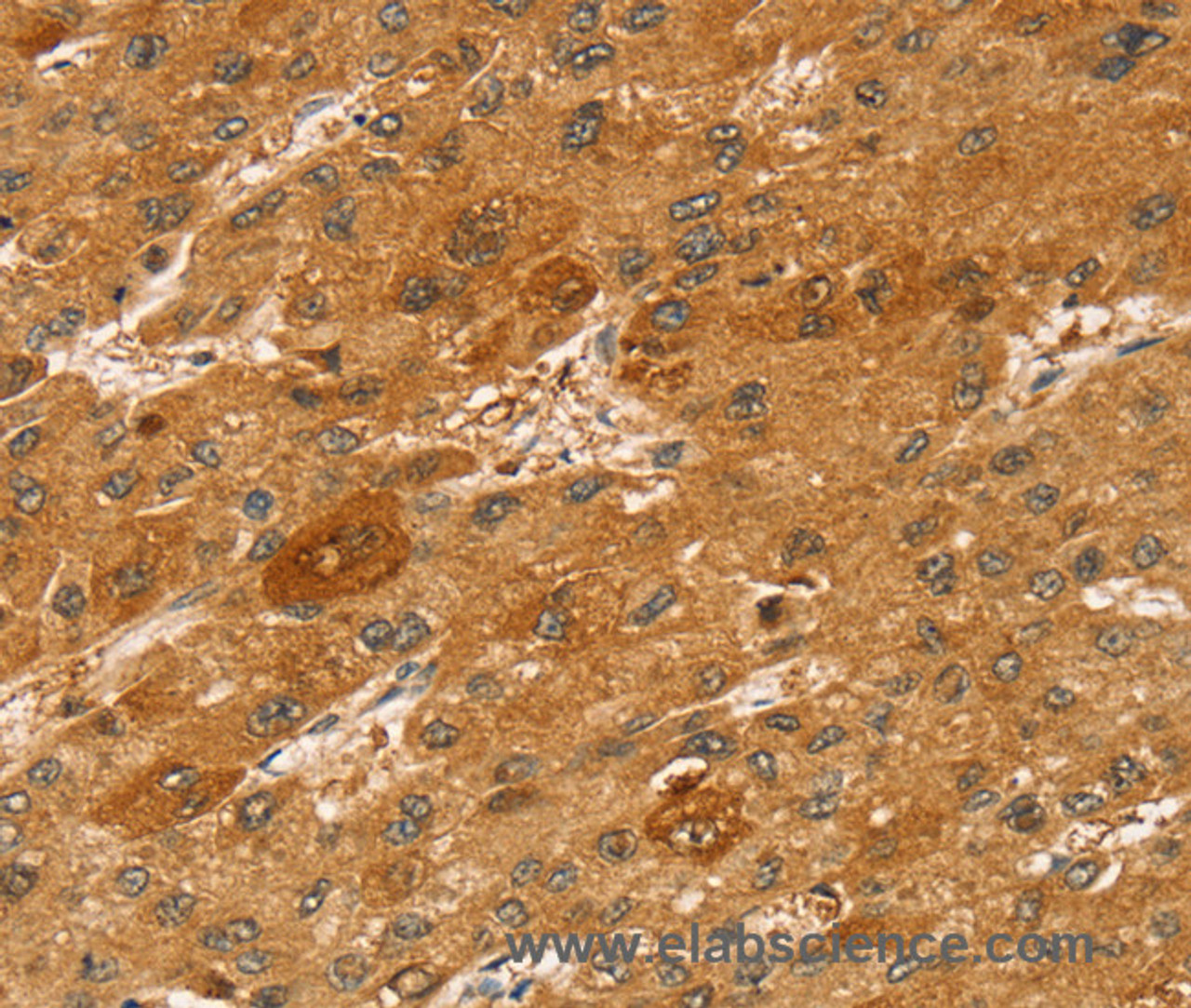 Immunohistochemistry of paraffin-embedded Human liver cancer tissue using STX2 Polyclonal Antibody at dilution 1:50