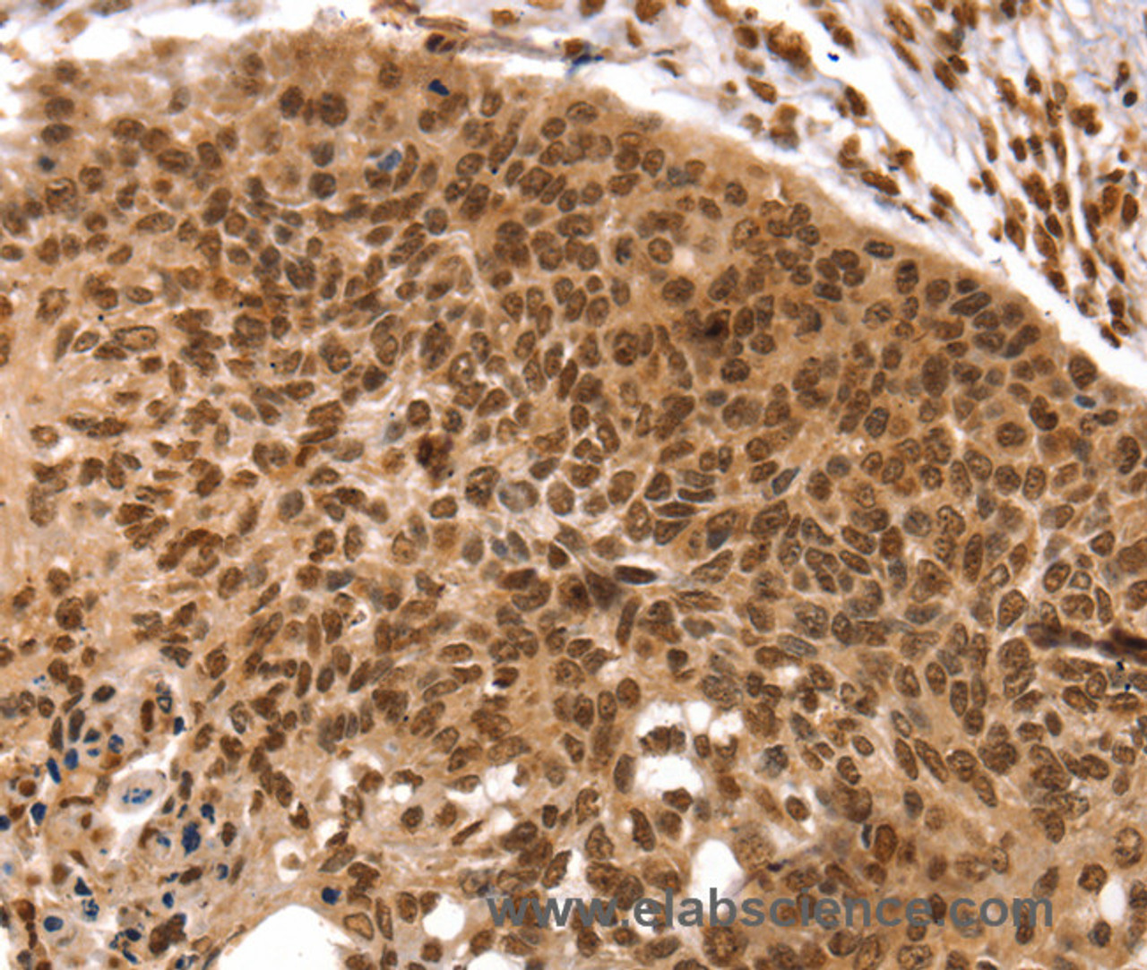 Immunohistochemistry of paraffin-embedded Human esophagus cancer using TAF10 Polyclonal Antibody at dilution of 1:35