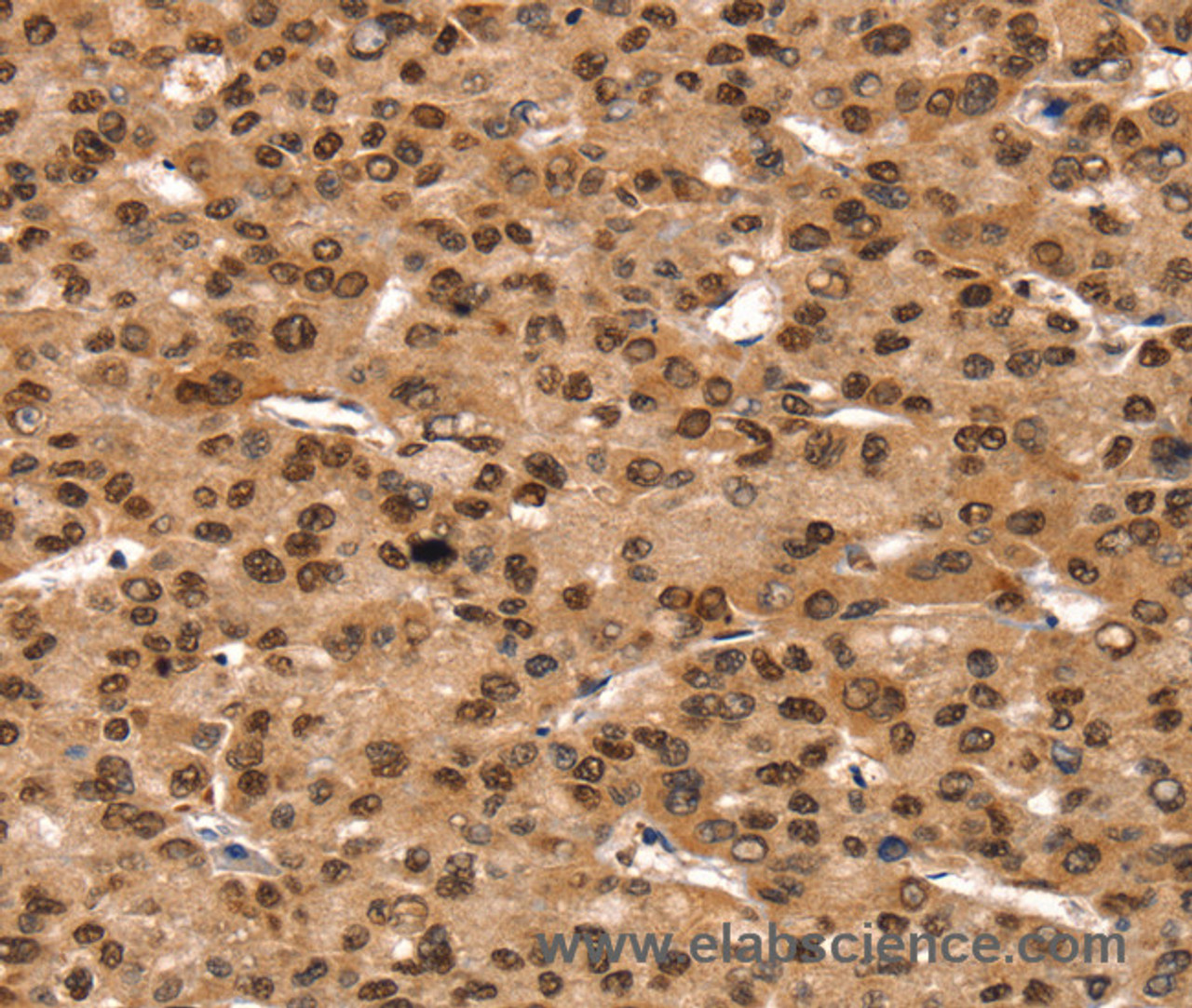 Immunohistochemistry of paraffin-embedded Human liver cancer using TAF10 Polyclonal Antibody at dilution of 1:35