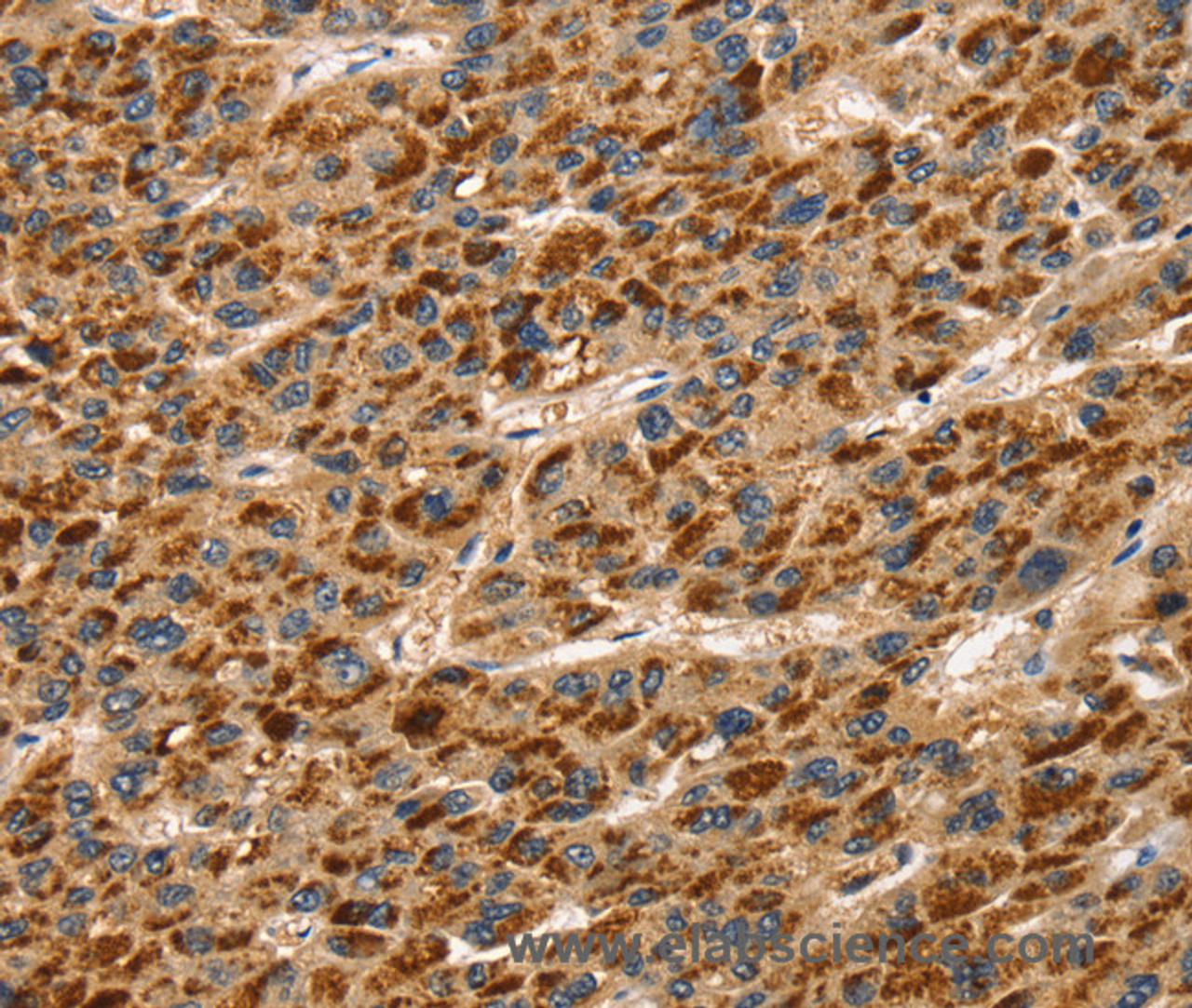 Immunohistochemistry of paraffin-embedded Human liver cancer using TLN1 Polyclonal Antibody at dilution of 1:30