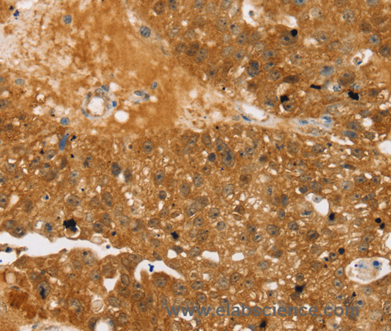 Immunohistochemistry of paraffin-embedded Human breast cancer using TBC1D4 Polyclonal Antibody at dilution of 1:40