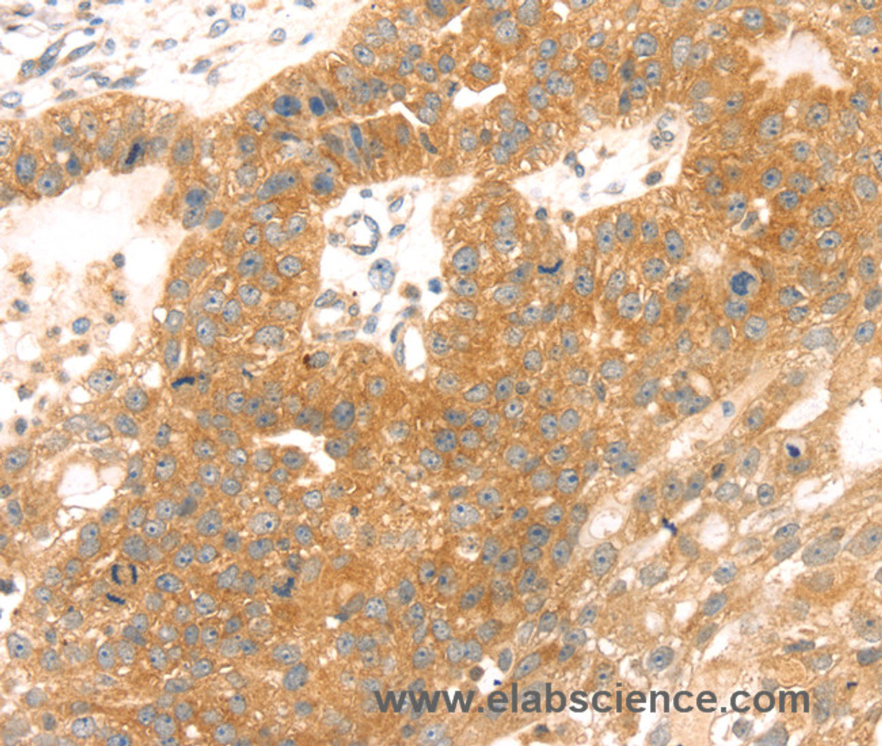 Immunohistochemistry of paraffin-embedded Human breast cancer tissue using TMEFF2 Polyclonal Antibody at dilution 1:35