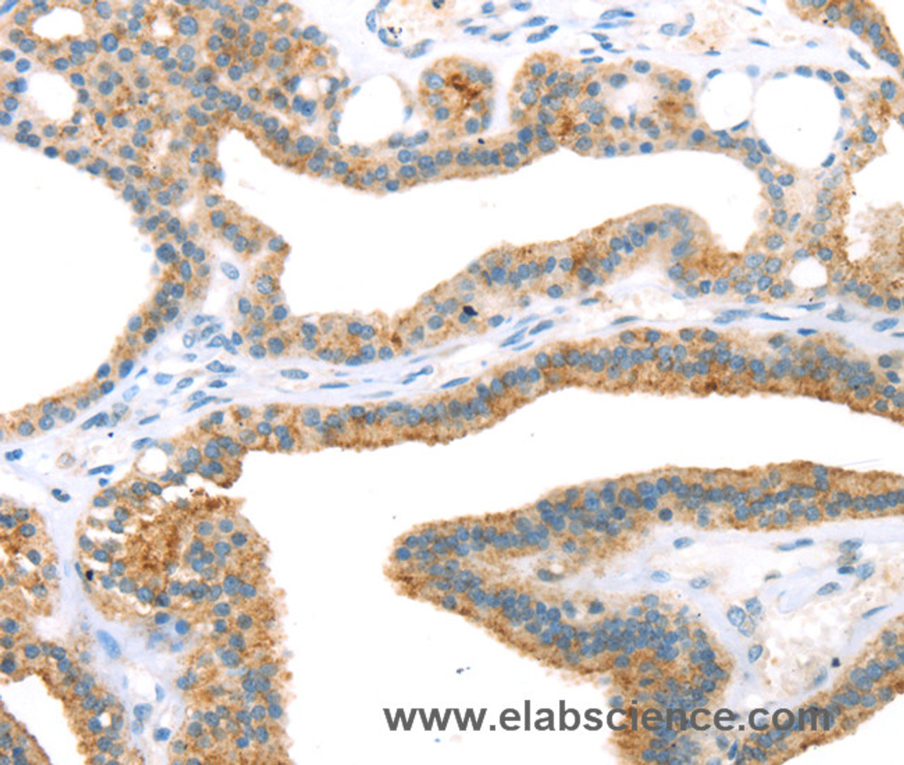 Immunohistochemistry of paraffin-embedded Human thyroid cancer using TNIP2 Polyclonal Antibody at dilution of 1:35