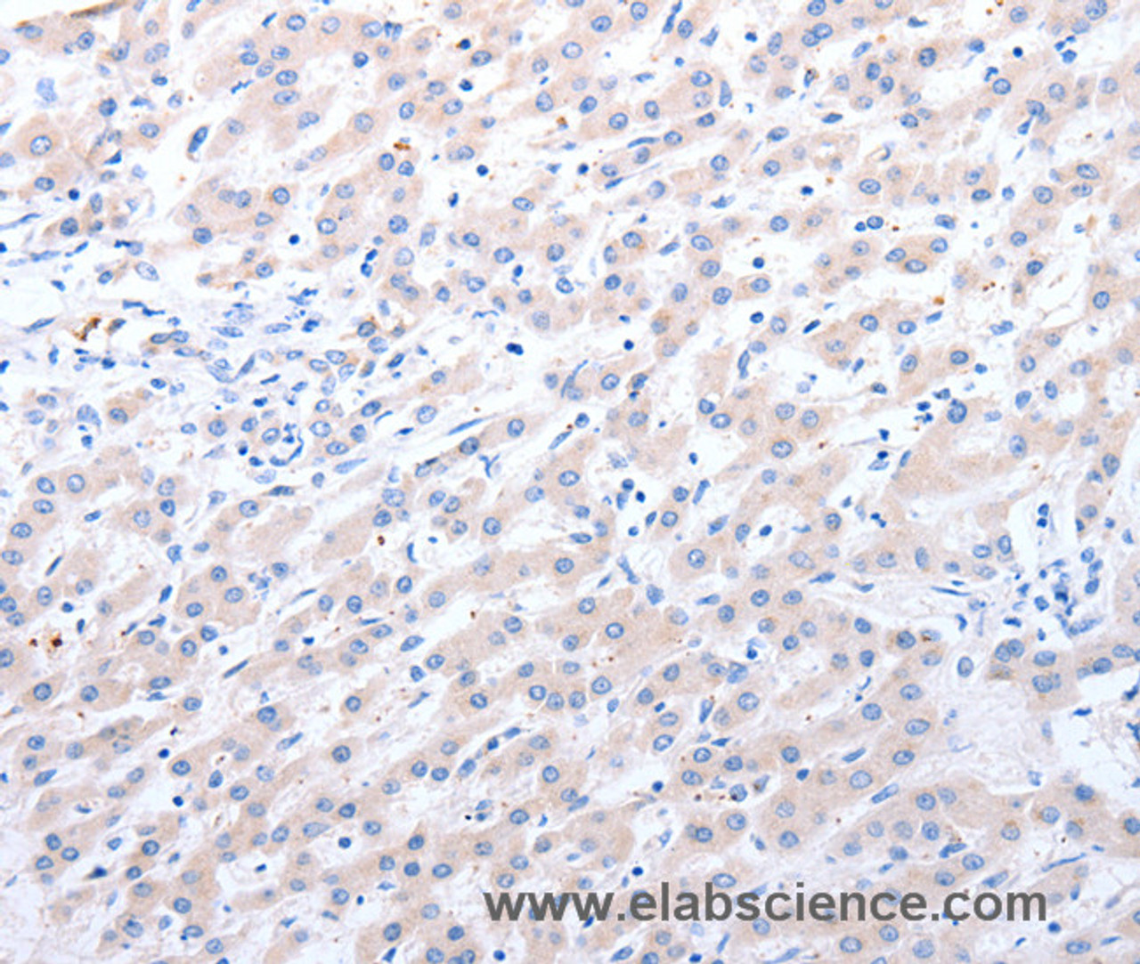Immunohistochemistry of paraffin-embedded Human liver cancer using ALDH1A1/2/3 Polyclonal Antibody at dilution of 1:40