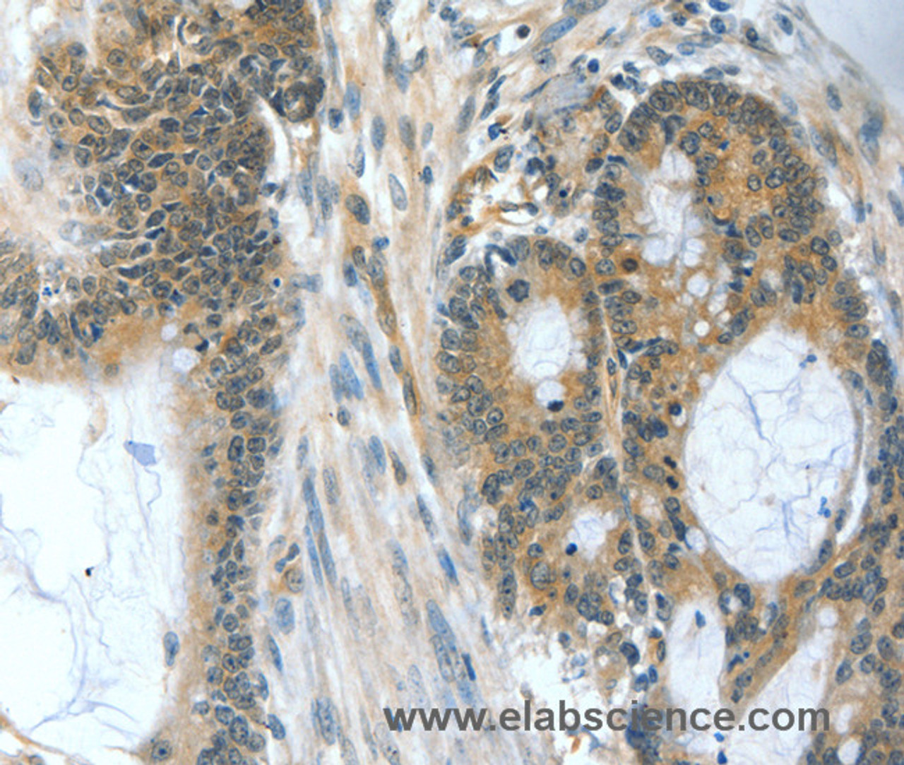 Immunohistochemistry of paraffin-embedded Human colon cancer tissue using BAD Polyclonal Antibody at dilution 1:60