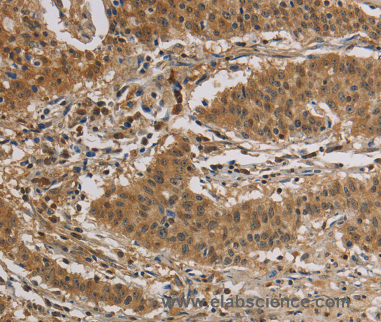Immunohistochemistry of paraffin-embedded Human gastic cancer using CASP3 Polyclonal Antibody at dilution of 1:30