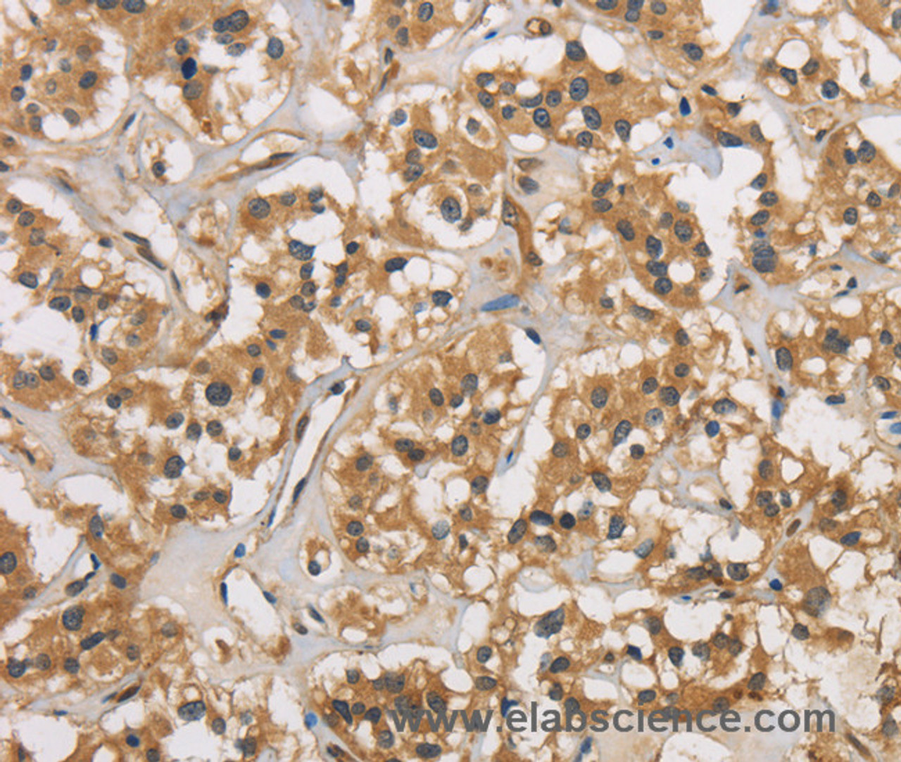 Immunohistochemistry of paraffin-embedded Human thyroid cancer using CASP3 Polyclonal Antibody at dilution of 1:30