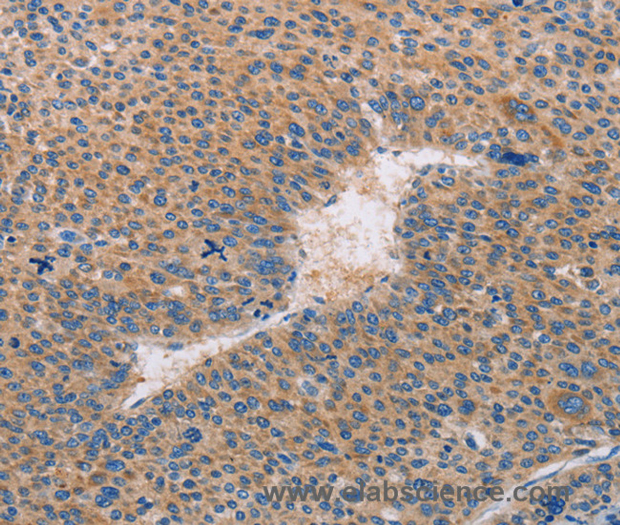 Immunohistochemistry of paraffin-embedded Human liver cancer tissue using CASP10 Polyclonal Antibody at dilution 1:30