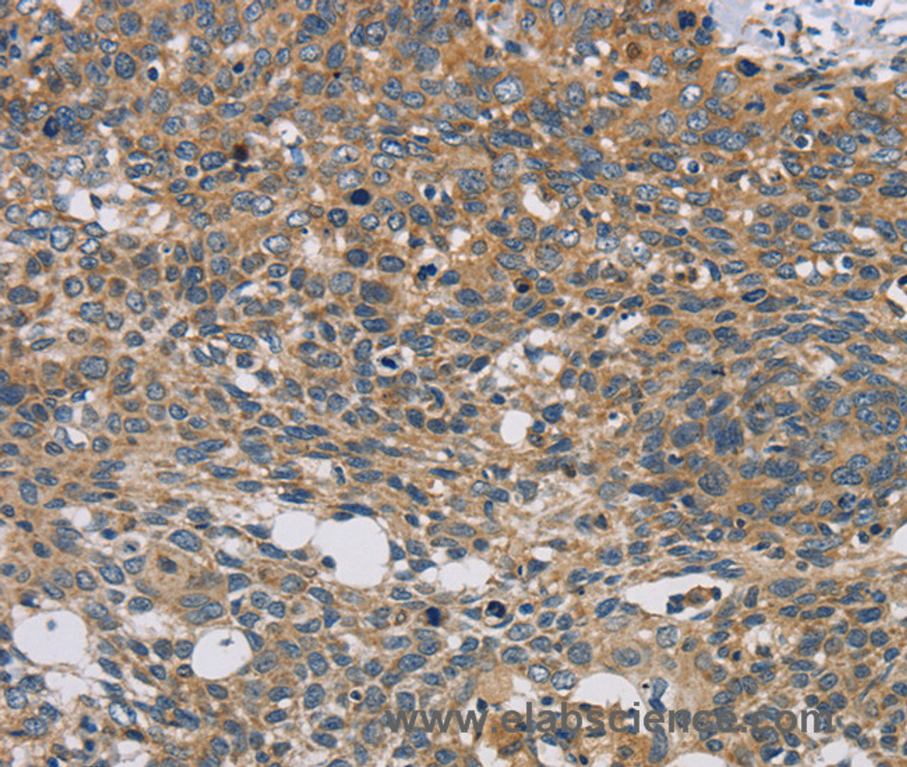 Immunohistochemistry of paraffin-embedded Human cervical cancer tissue using STAT4 Polyclonal Antibody at dilution 1:30