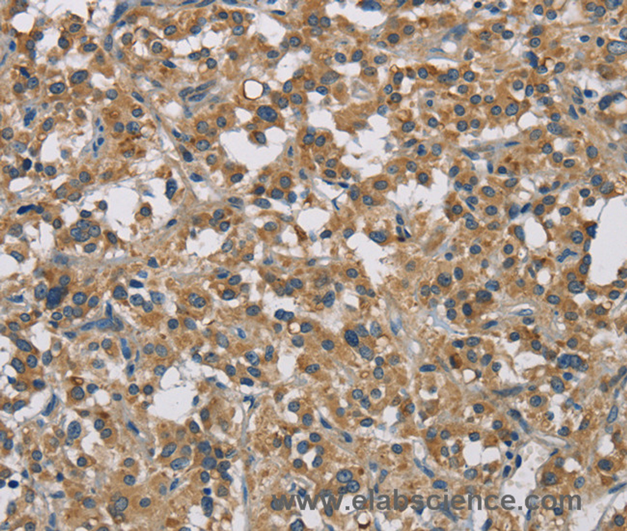 Immunohistochemistry of paraffin-embedded Human thyroid cancer tissue using STAT4 Polyclonal Antibody at dilution 1:30